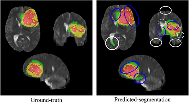 medical image segmentation